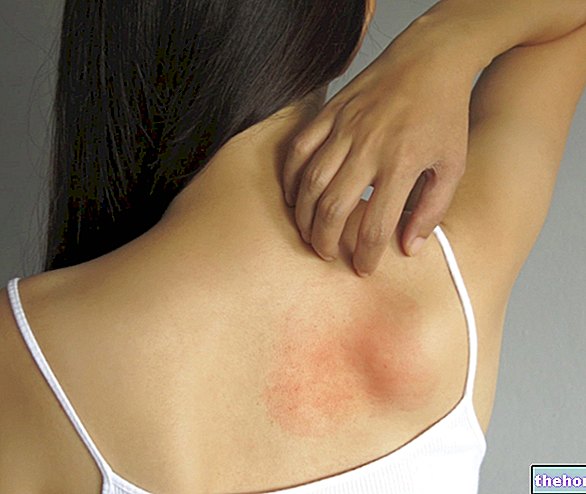 Allerginen dermatiitti