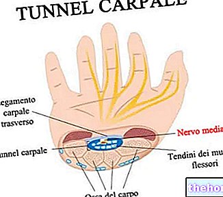 Tunnel carpien