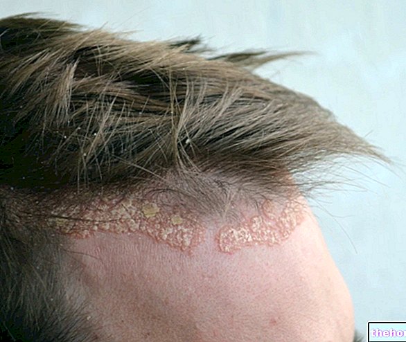 Psoriasis kulit kepala