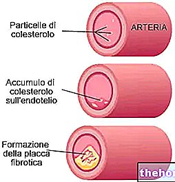Атеросклероза