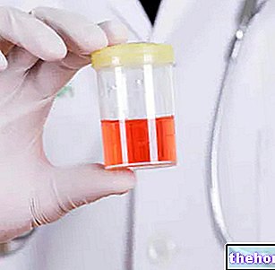Hémoglobine dans l'urine - Hémoglobinurie