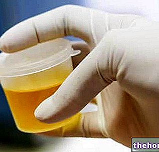 Glucose dans l'urine - Glycosurie
