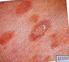 Pitiriasis rosada de Gibert: diagnóstico y terapias