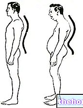 मोटापा: क्या वजन घटाने से पीठ के निचले हिस्से में दर्द में सुधार होता है?