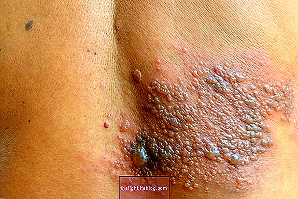 Qu'est-ce que c'est et comment traiter la dermatite herpétiforme