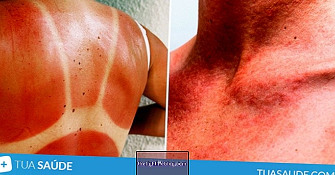 Comment identifier et traiter les 6 maladies de peau les plus courantes en été
