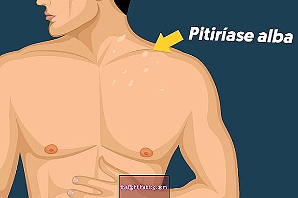 Qu'est-ce que Pityriasis alba et comment le traiter