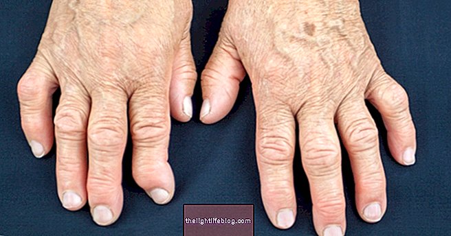 Qu'est-ce que l'arthrite, les symptômes, le diagnostic et le traitement