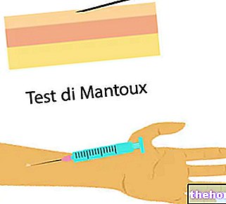 Mantouxi test