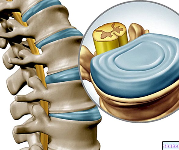Междупрешленни дискове и болки в гърба