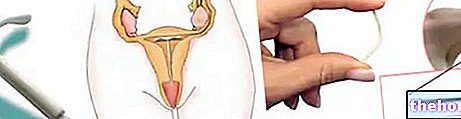 Contraceptifs implantables : stérilet spirale et bâtonnets