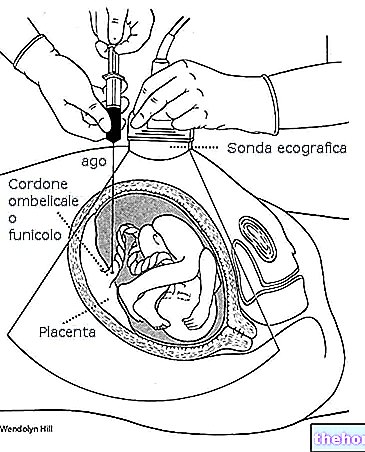 Cordocentèse - Funicolocentèse