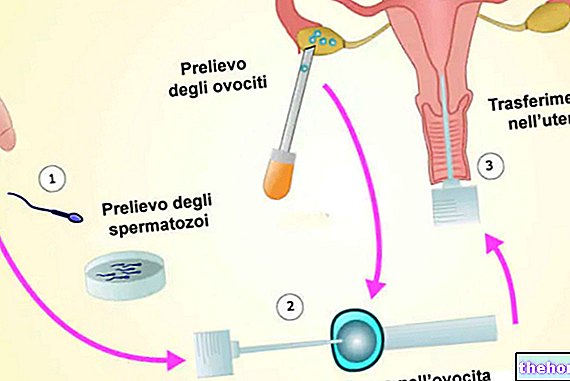 ICSI - Injection intracytoplasmique de spermatozoïdes