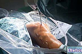 शल्य चिकित्सा-हस्तक्षेप - घुटने की आर्थ्रोस्कोपी