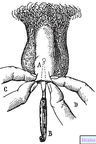 Frénuloplastie