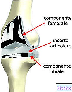 Prótesis de rodilla