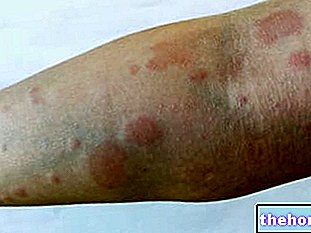 Lupus eritematoso sistémico: qué es, causas y factores de riesgo