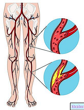Arteriopati Periferal