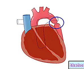 Koarktácia aorty - koarktácia aorty