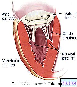 Mitral Insufficiency