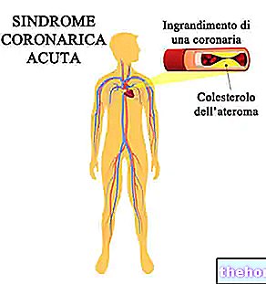 Syndrome coronarien aigu
