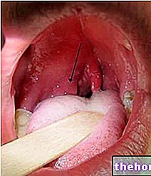 Peritonsillar abscess