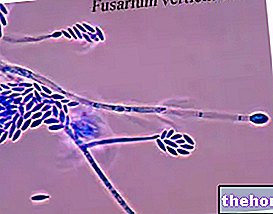maladies infectieuses - Fusarium