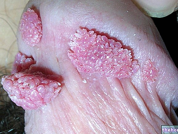 Papilloomiviiruse haigused