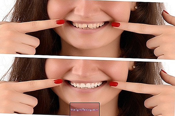 Facettes dentaires en résine ou en porcelaine: avantages et inconvénients