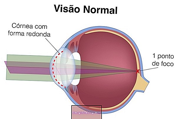 Qu'est-ce que l'astigmatisme, comment identifier et traiter
