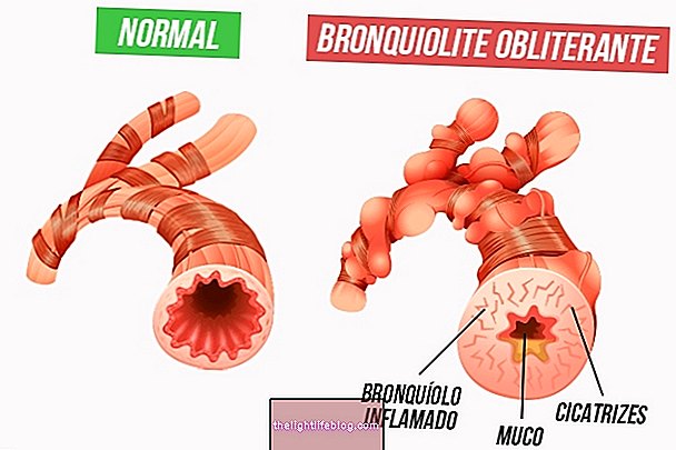 Qu'est-ce que la bronchiolite oblitérante, ses symptômes, ses causes et comment la traiter