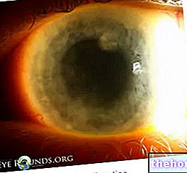 zdravje oči - Keratitis: simptomi, zdravljenje in preprečevanje