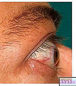 Exophthalmos (punnis silmad)