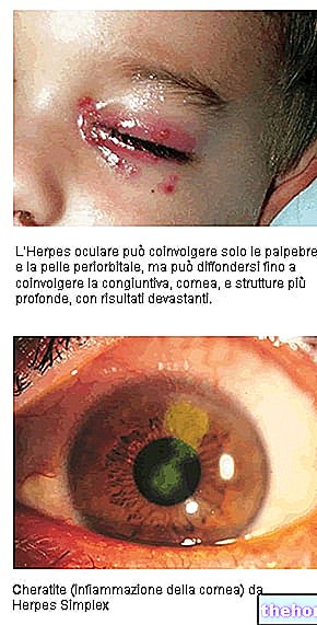 Očesni herpes