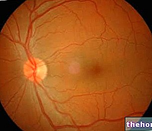 Hypertenzná retinopatia