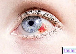 Rupture des capillaires oculaires