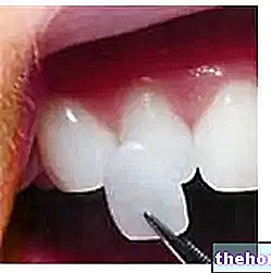 Zubné fazety: intervencia a údržba
