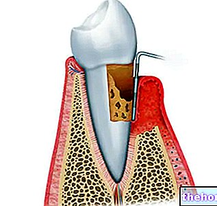 Infection dentaire : complications et prévention