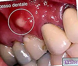 Classification des infections dentaires, causes, symptômes et traitements
