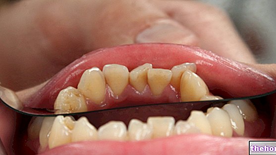 Видалення зубів впливає на VO2