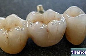 Зубний міст