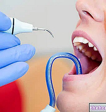 Избелване на зъби