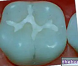 Герметизація зубів