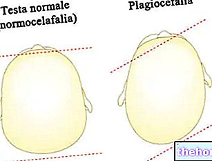 Plagiocephalia