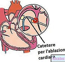 Ablation cardiaque