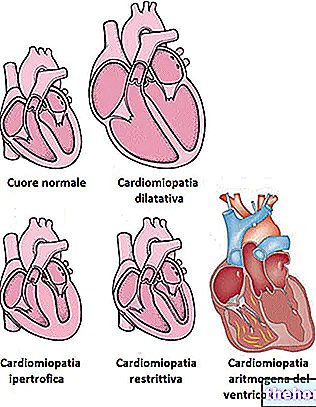 Cardiomyopathie - Cardiomyopathies