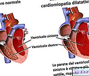 Razširjena kardiomiopatija