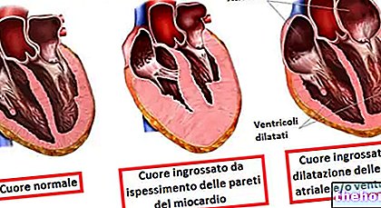 Povečano srce - kardiomegalija