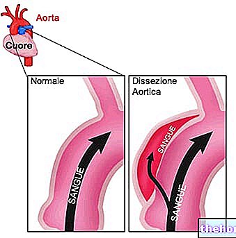 Dissection de l'aorte