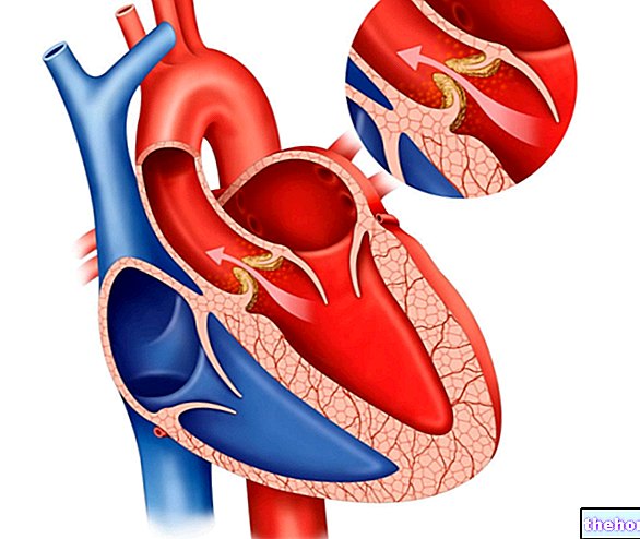 Stenóza aorty: Príčiny, symptómy a liečba